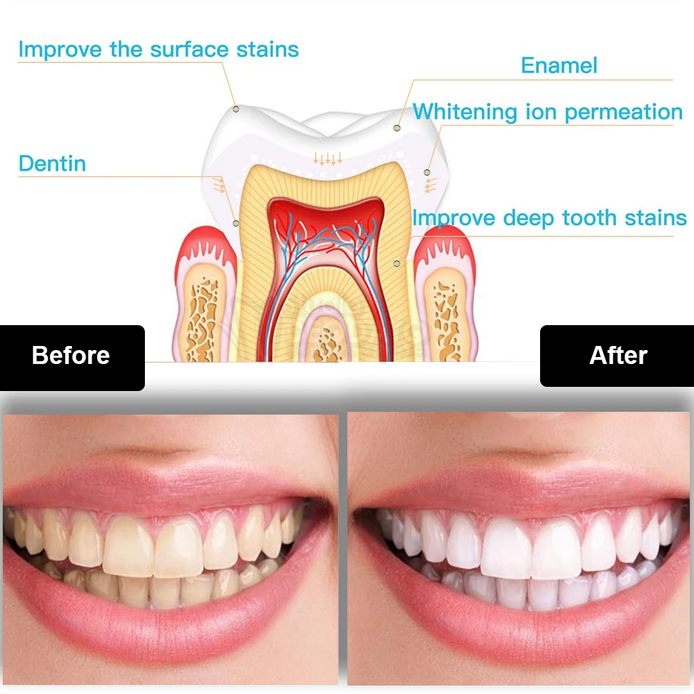 Dental Teeth Whitening Kit Min - Teeth Whitening Pens recension och pris